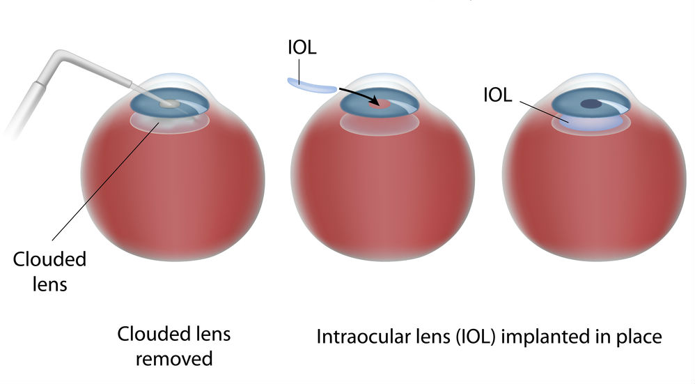 Intraocular Lens IOLs Redding Red Bluff Chico CA